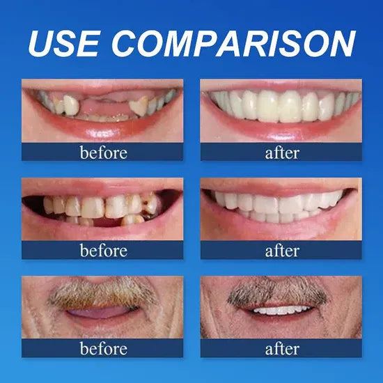 🌎Ends Today: 80% OFF!⏰FRASIRA™ Custom-Fit Smile Support Kit — Strong Suction Feel & Natural-Looking Fit