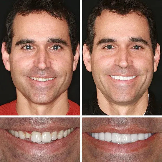 🌎Ends Today: 80% OFF!⏰FRASIRA™ Custom-Fit Smile Support Kit — Strong Suction Feel & Natural-Looking Fit