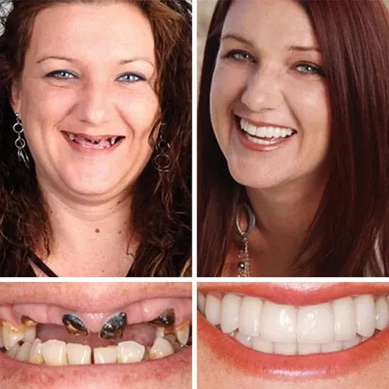 🌎Ends Today: 80% OFF!⏰FRASIRA™ Custom-Fit Smile Support Kit — Strong Suction Feel & Natural-Looking Fit