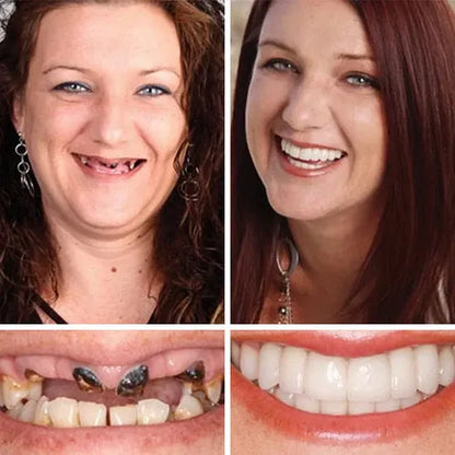 🌎Ends Today: 80% OFF!⏰FRASIRA™ Custom-Fit Smile Support Kit — Strong Suction Feel & Natural-Looking Fit