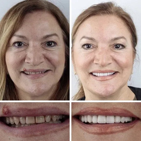🌎Ends Today: 80% OFF!⏰FRASIRA™ Custom-Fit Smile Support Kit — Strong Suction Feel & Natural-Looking Fit